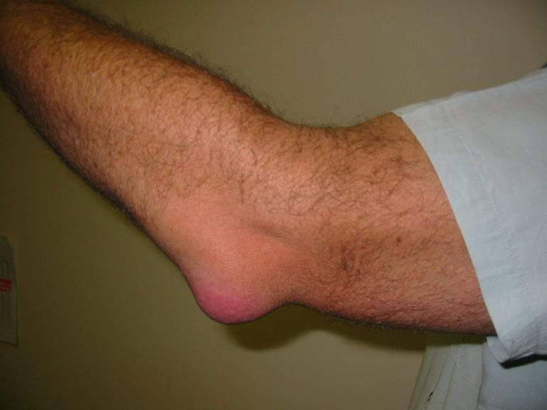 Supplements for bursitis