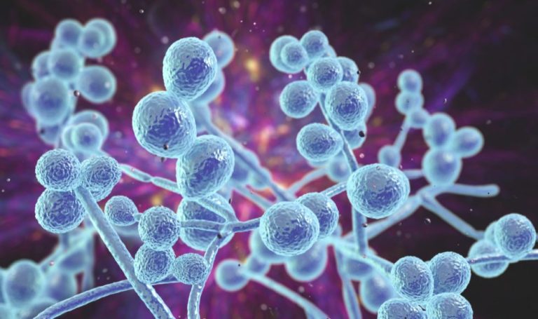 Candidiasis