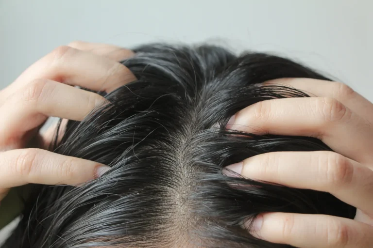Dandruff
