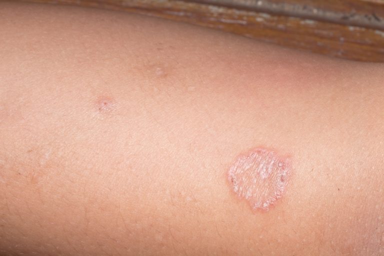 Ringworm