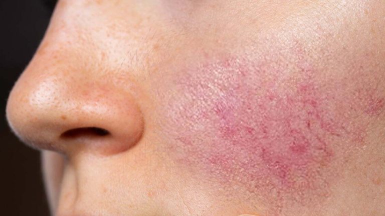 Rosacea