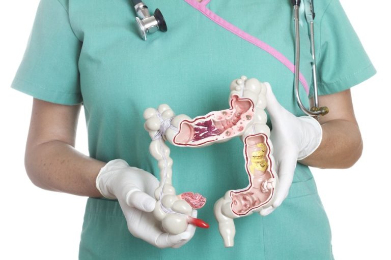 Ulcerative colitis