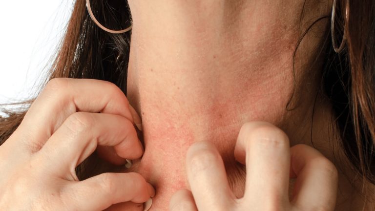 Stressed, anxious and dealing with eczema