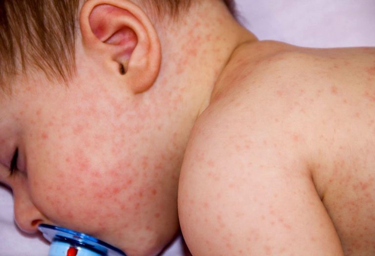 Common rashes in babies and children