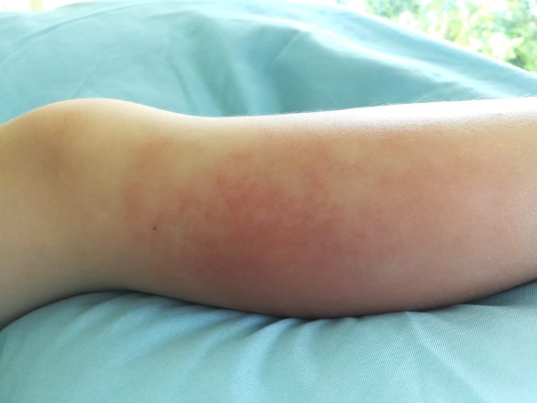 Cellulitis in children