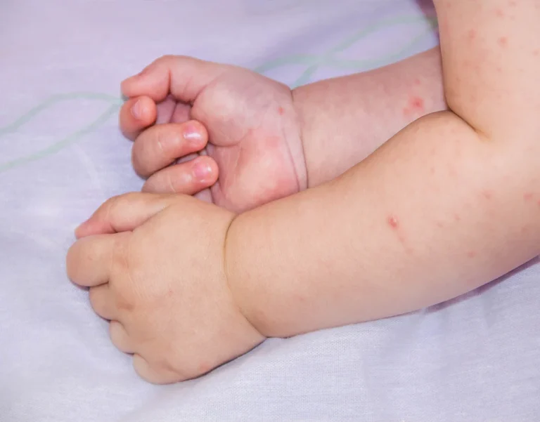 Identifying allergic rashes on babies and children