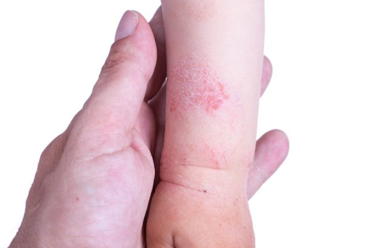 Dermatitis and eczema on babies