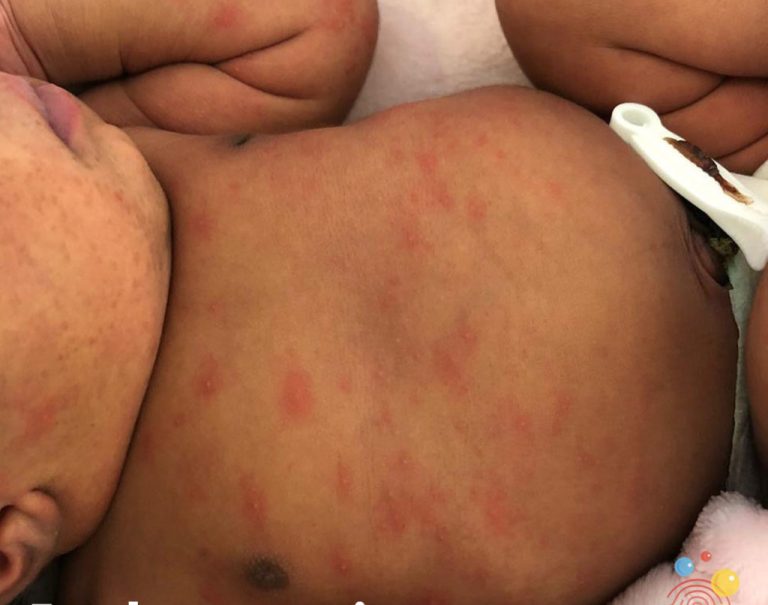 Erythema toxicum
