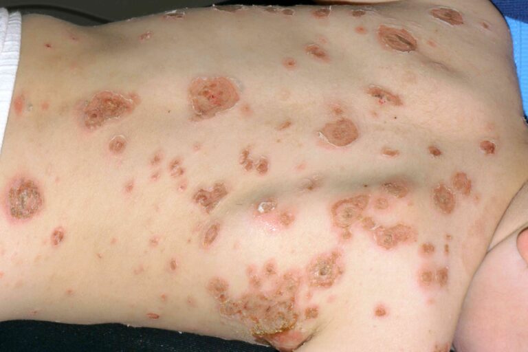 Impetigo