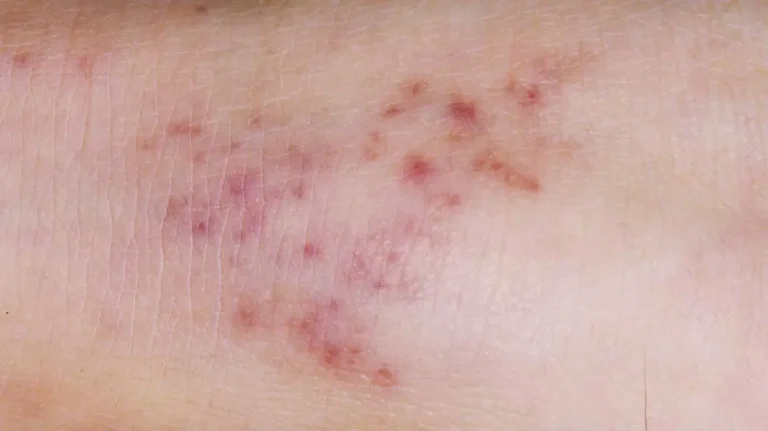 Meningitis