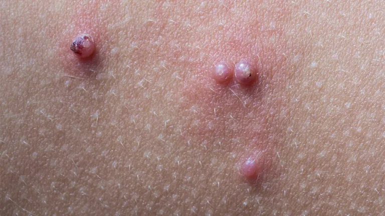 Molluscum contagiosum