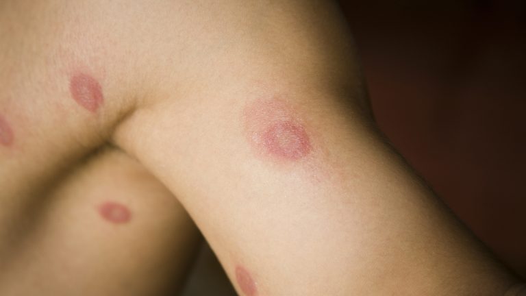 Ringworm on children