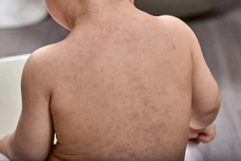 Roseola Infantum