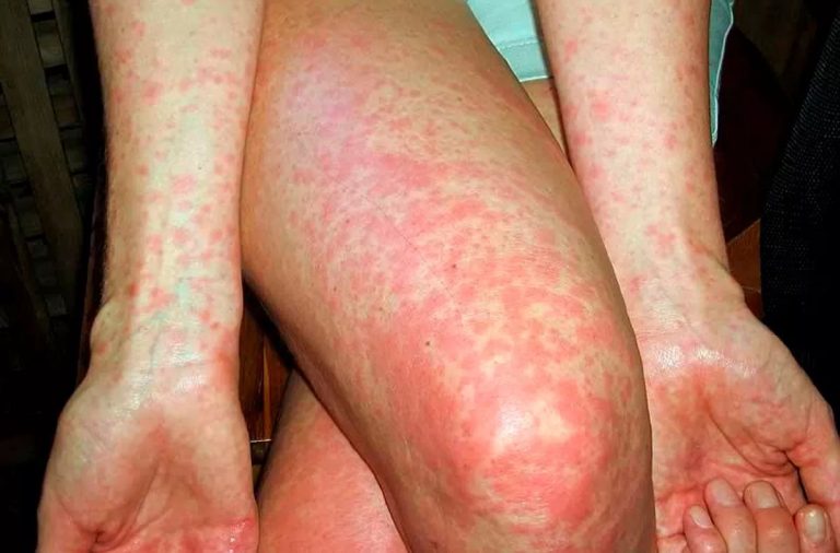 Scarlet fever