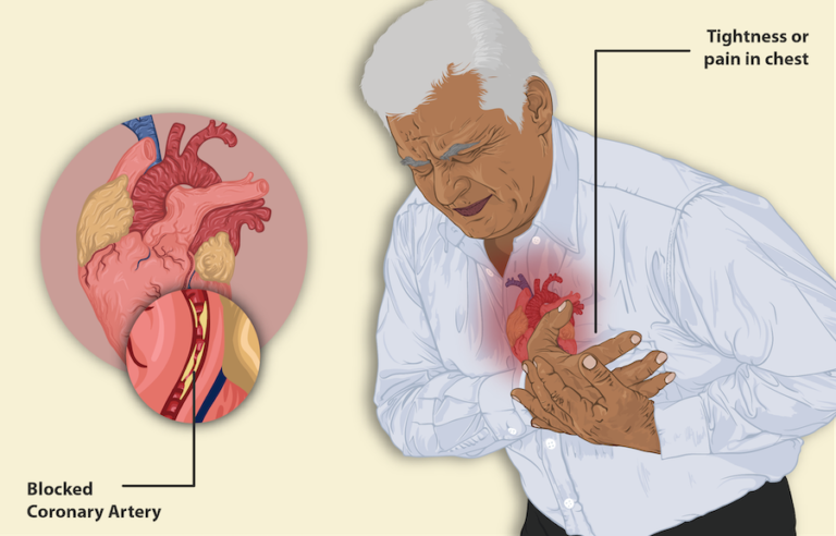 When is chest pain a heart attack