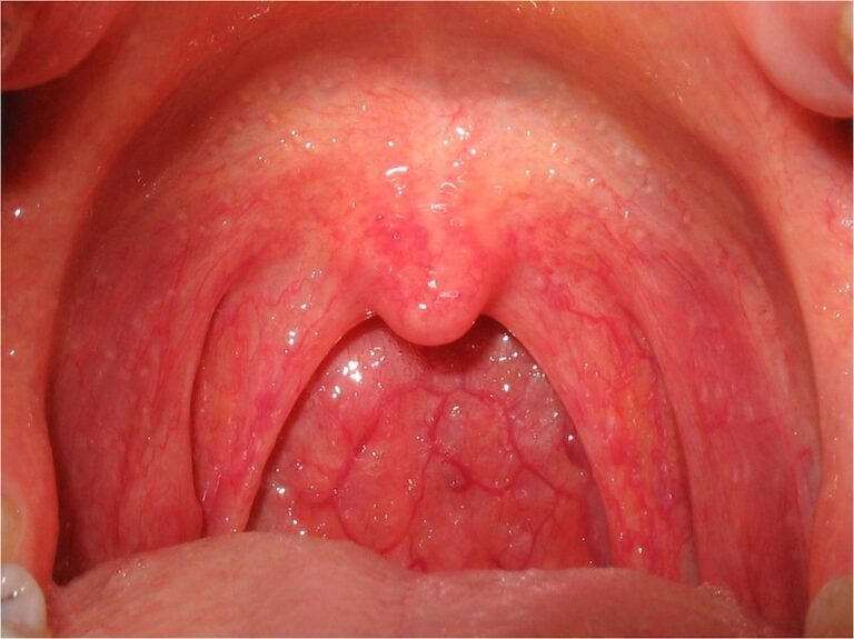 Pharyngitis