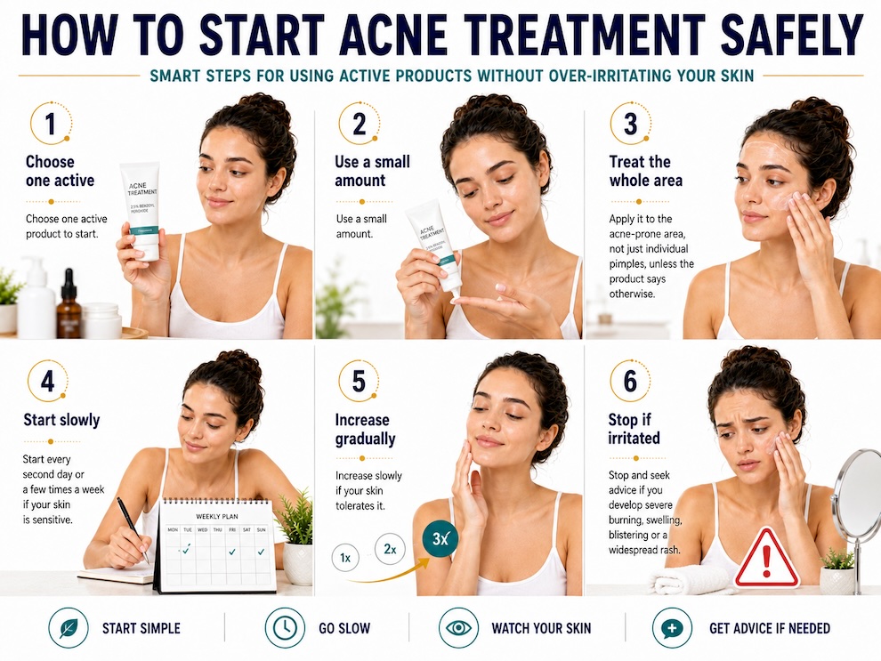 Starting acne treatments safely